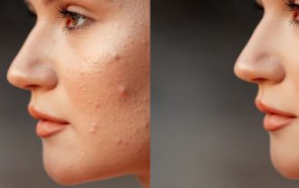 DIY acne treatment remedies